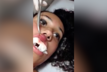 (Vidéo) Brésil : Les médecins découvrent une larve de mouche à l’intérieur de sa lèvre