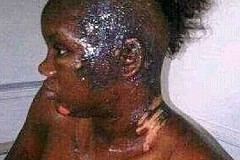 (Photo) Nigeria : Elle arrose la maîtresse de son mari à l'acide