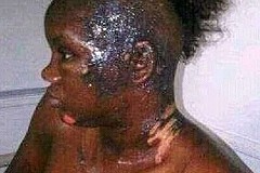 (Photo) Nigeria : Elle arrose la maîtresse de son mari à l'acide (Photo) Nigeria : Elle arrose la maîtresse de son mari à l'acide
