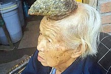 Chine : Malade, une corne lui pousse sur la tête