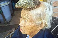 Chine : Malade, une corne lui pousse sur la tête Chine : Malade, une corne lui pousse sur la tête