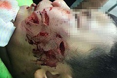 Défiguré par les morsures de son propre chien Défiguré par les morsures de son propre chien