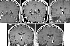 Etats-Unis : Un ver solitaire élit domicile dans son cerveau