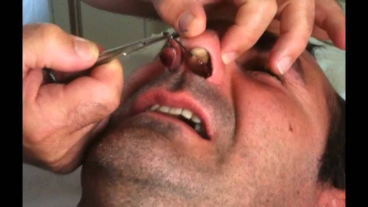 Les Polypes Du Nez Polypes Nasaux Lebabi Net