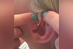 (Vidéo) Elle perce un bouton vieux de 6 ans 