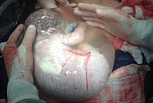 (Vidéo) Venezuela : Un bébé vient au monde dans sa poche amniotique 
