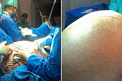 (Photos) Inde : Une tumeur de 95 kilogrammes retirée du ventre d'une patiente