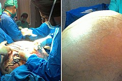 (Photos) Inde : Une tumeur de 95 kilogrammes retirée du ventre d'une patiente (Photos) Inde : Une tumeur de 95 kilogrammes retirée du ventre d'une patiente