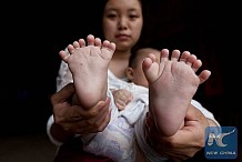 (Photos) Un bébé chinois né avec 15 doigts et 16 orteils
