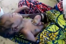 Nigeria : Un bébé naît avec le cœur hors de la cage thoracique  