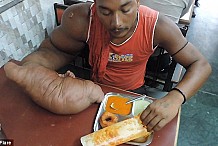 Atteint d’une maladie rare, le bras droit de cet homme pèse plus de 20 kilos (vidéo)