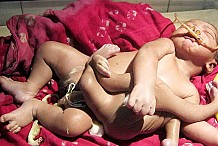 Une femme donne naissance à un bébé avec 4 pieds
