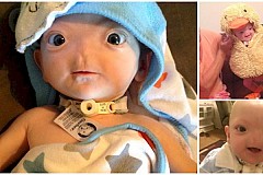 Ce bébé est né sans nez (photos)
