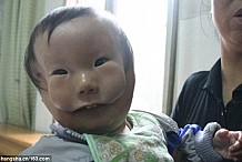 Une malformation rare dédouble le visage de cet enfant (photos)