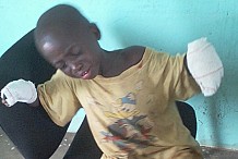 Vavoua : pour un vol de 350 FCFA, un père brûle les mains de son fils de 6 ans
