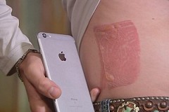 Brûlé au second degré par son iPhone Brûlé au second degré par son iPhone