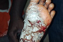 Gagnoa : Une dame brûle les pieds de sa nièce de 6 ans pour l'empêcher de sortir