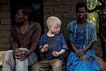 Mozambique: un albinos assassiné, son cerveau emporté