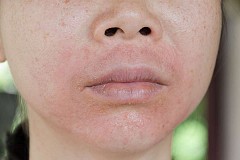 Eczéma
5 remèdes naturels pour se débarrasser de ce trouble
Eczéma
5 remèdes naturels pour se débarrasser de ce trouble