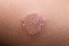 La teigne
Voici les causes possibles et les remèdes à la maison pour cette infection de peau
La teigne
Voici les causes possibles et les remèdes à la maison pour cette infection de peau
