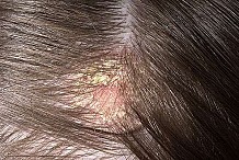 6 façons naturelles de traiter la perte de cheveux causée par les pellicules