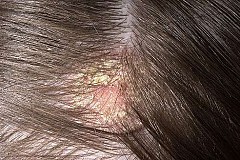 6 façons naturelles de traiter la perte de cheveux causée par les pellicules 6 façons naturelles de traiter la perte de cheveux causée par les pellicules