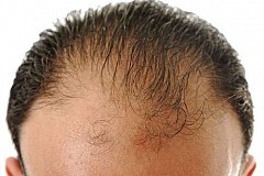 Perte de cheveux
Voici 5 façons naturelles de traiter cette maladie

