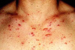 Acné
Voici les causes possibles, les traitements et la prévention des boutons du corps
Acné
Voici les causes possibles, les traitements et la prévention des boutons du corps