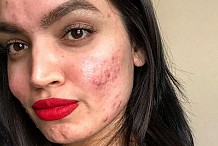 La compagnie de beauté L'Oréal  sous le feu pour un blogueur acné 'humiliant'
