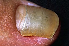 Bien-être
Causes et traitement de la chute des ongles
Bien-être
Causes et traitement de la chute des ongles