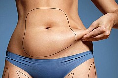 Le guide ultime de la liposuccion