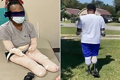 Les mains et les pieds d’une femme amputés après avoir contracté la Covid-19 Les mains et les pieds d’une femme amputés après avoir contracté la Covid-19