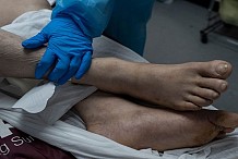 Erreur médicale : une chirurgienne ampute la mauvaise jambe d’un patient