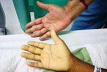 Anémie chez les adolescents: Santé : Les parasites et le déficit en vitamine B12 sont les causes