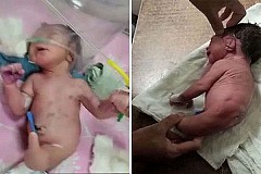 Un bébé né avec une corne étrange au lieu de jambes laisse les médecins perplexes-Photos