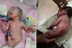Un bébé né avec une corne étrange au lieu de jambes laisse les médecins perplexes-Photos Un bébé né avec une corne étrange au lieu de jambes laisse les médecins perplexes-Photos