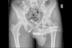 Un adolescent de 15 ans hospitalisé après s'être introduit un câble USB dans son pénis Un adolescent de 15 ans hospitalisé après s'être introduit un câble USB dans son pénis