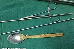 Une cuillère de 20 cm logée dans sa gorge pendant un an Une cuillère de 20 cm logée dans sa gorge pendant un an