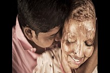 Inde-émouvant: Défigurée et aveuglée à l’acide, elle trouve l’amour à l’hôpital
