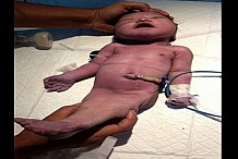 Inde-insolite : une maman donne naissance à un « bébé sirène » (photos)