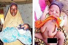 Nigeria/Insolite : elle donne naissance à un bébé avec quatre mains et trois jambes