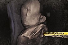 Un bébé né sans visage bouleverse le Portugal