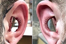 Australie : Un homme se fait enlever l’intérieur des oreilles (photo)