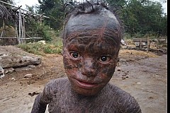 Inde : âgé de 10 ans, il souffre d’une maladie qui lui fait perdre la peau comme un reptile (photos)