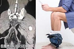 Chine: Le rectum d’un homme tombe pour s’être assis trop longtemps…