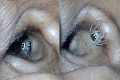 Inde-insolite : une araignée vivante découverte dans l’oreille d’une femme (vidéo) Inde-insolite : une araignée vivante découverte dans l’oreille d’une femme (vidéo)